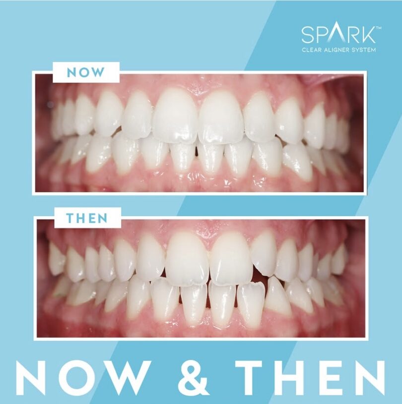spark clear aligners
