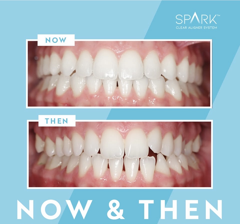 Spark Clear Aligners in Manchester- How Good are They? | Cheadle Hulme ...