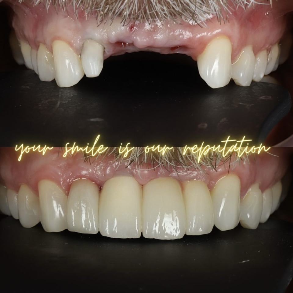 dental implants in manchester