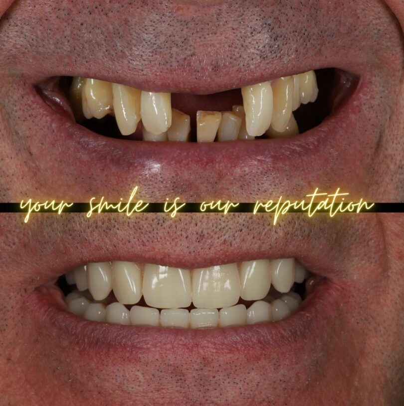 dental implants in manchester