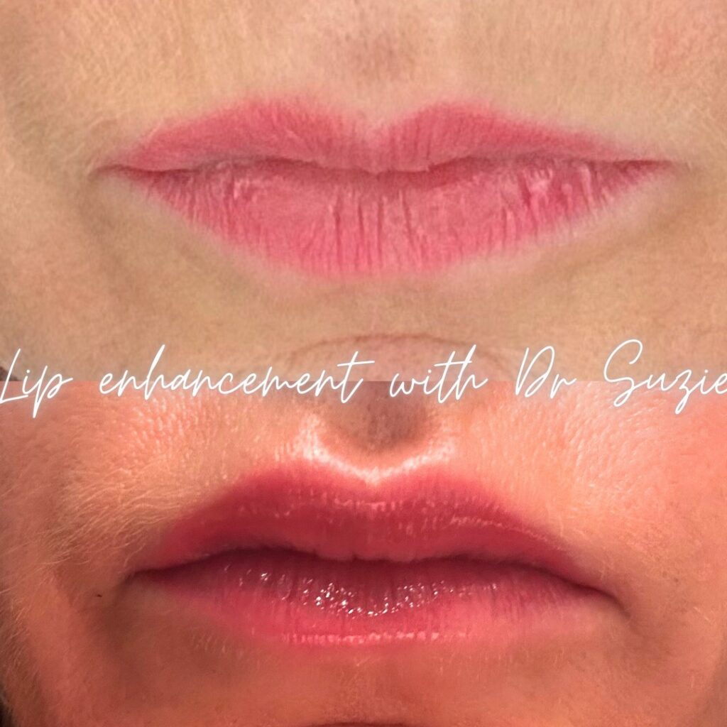 natural lip enhancement manchester