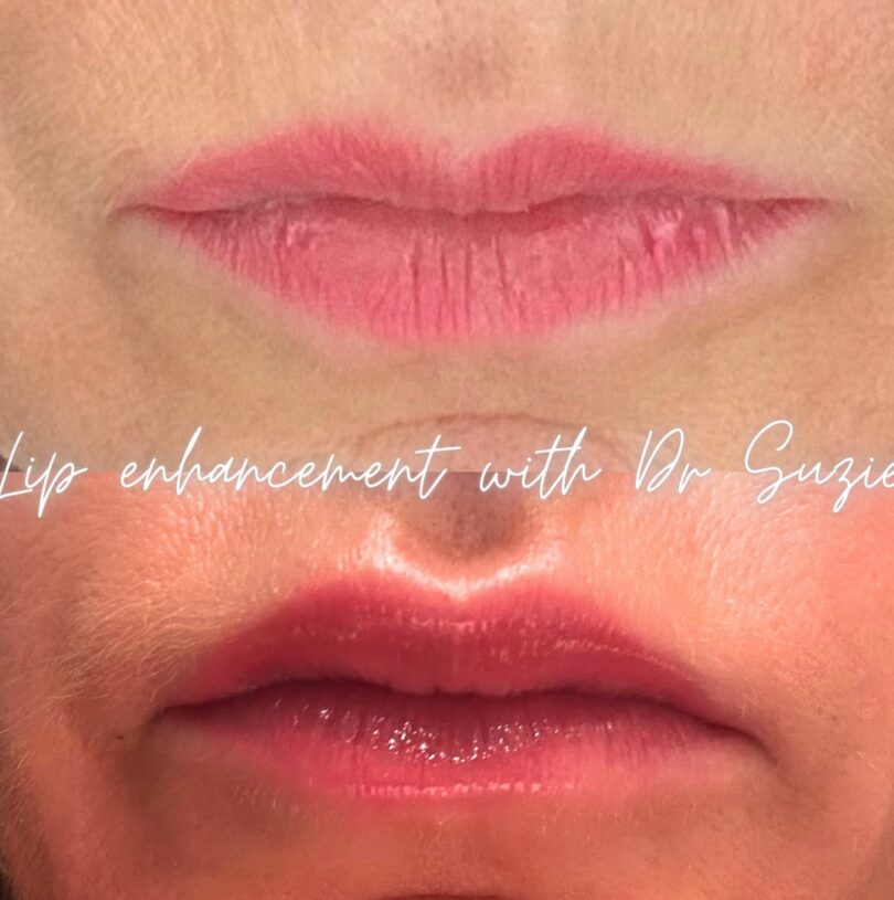 natural lip enhancement manchester