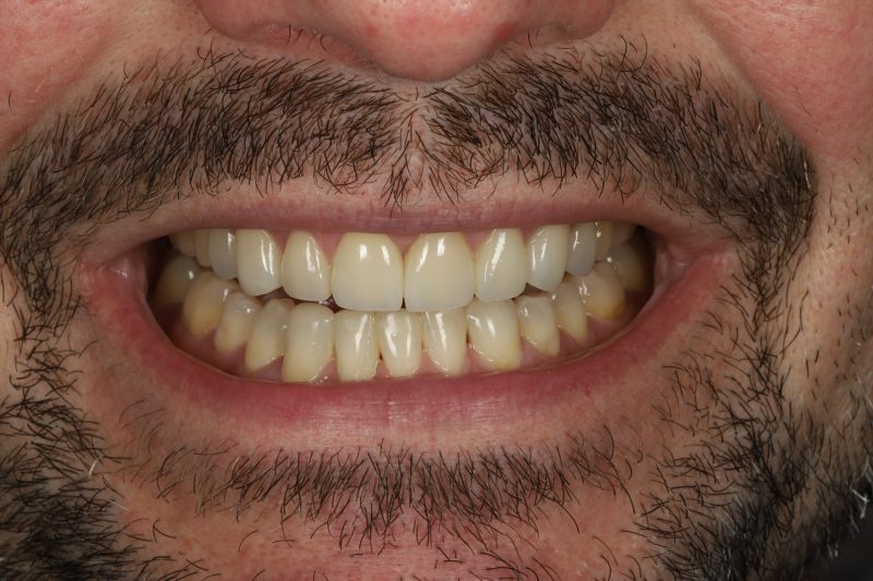 DE10 After - Cheadle Hulme Dental