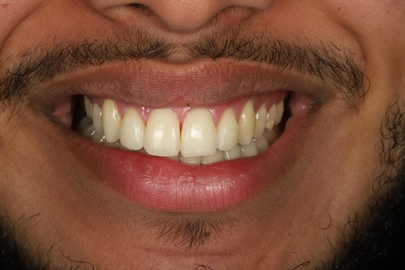 DE11 After - Cheadle Hulme Dental