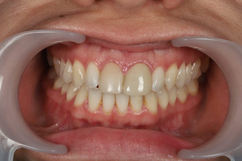 DE23 Before - Cheadle Hulme Dental