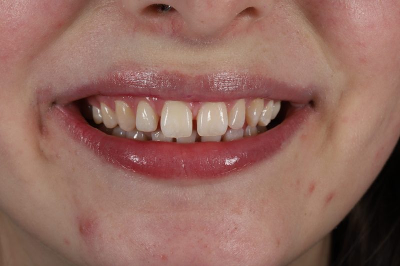 DE28 Before - Cheadle Hulme Dental