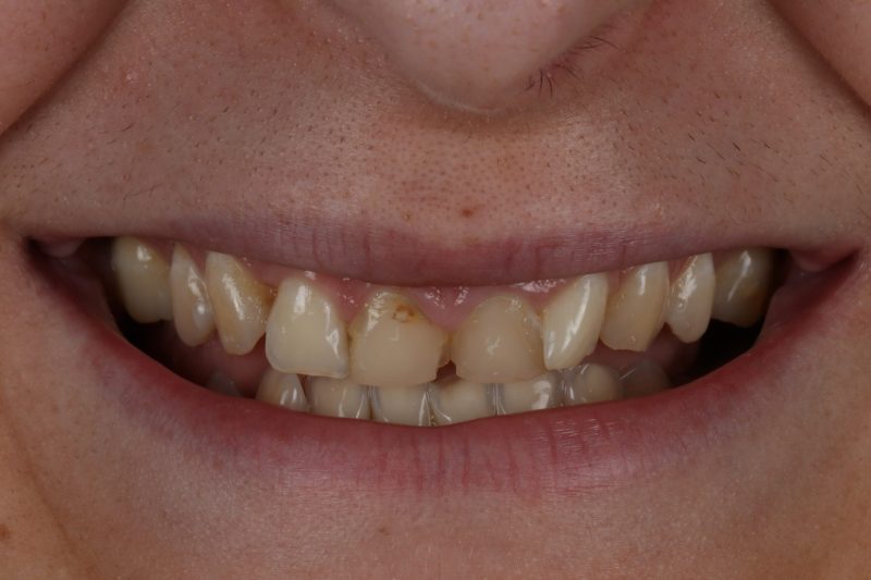 DE33 Before - Cheadle Hulme Dental