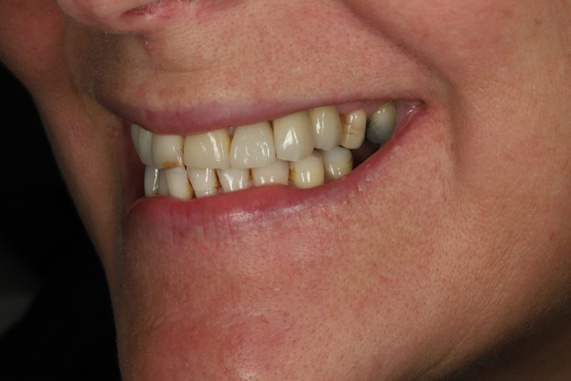 DE4 After - Cheadle Hulme Dental