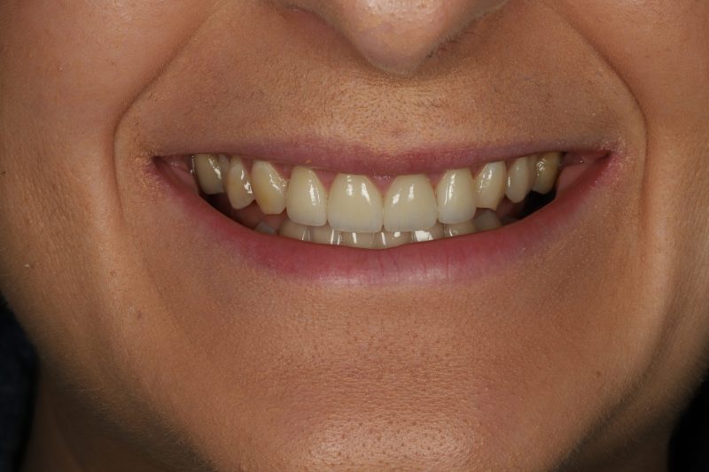 DE5 After - Cheadle Hulme Dental