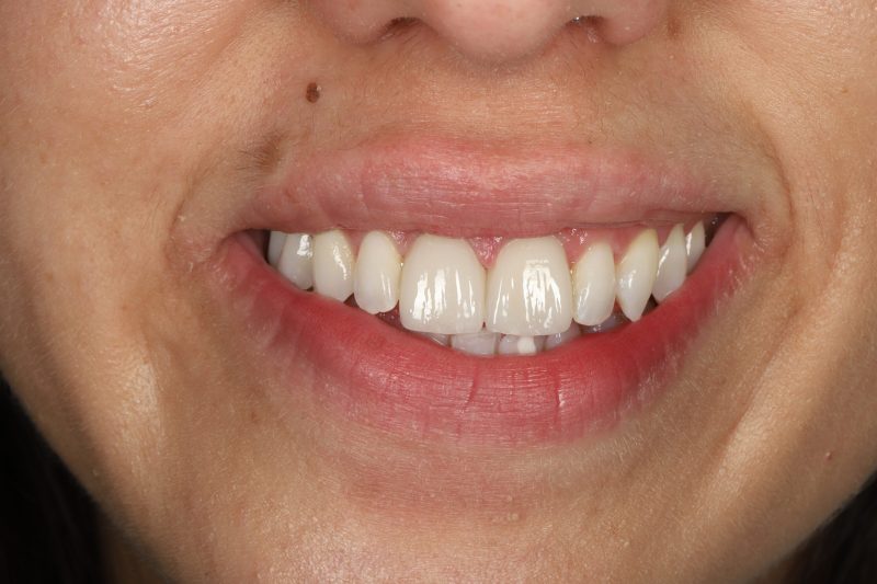 DE6 After - Cheadle Hulme Dental