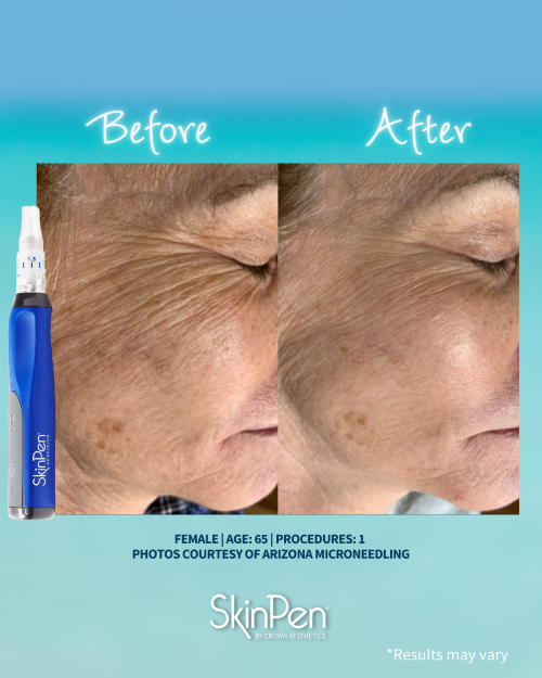 SkinPen in Manchester