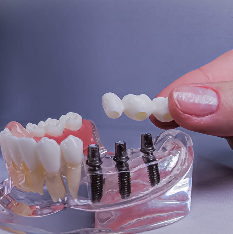 blog - Cheadle Hulme Dental