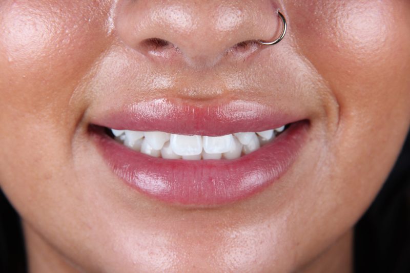 IMG_0010 Before - Cheadle Hulme Dental