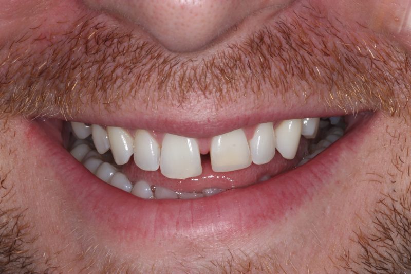 IMG_0055 Before - Cheadle Hulme Dental