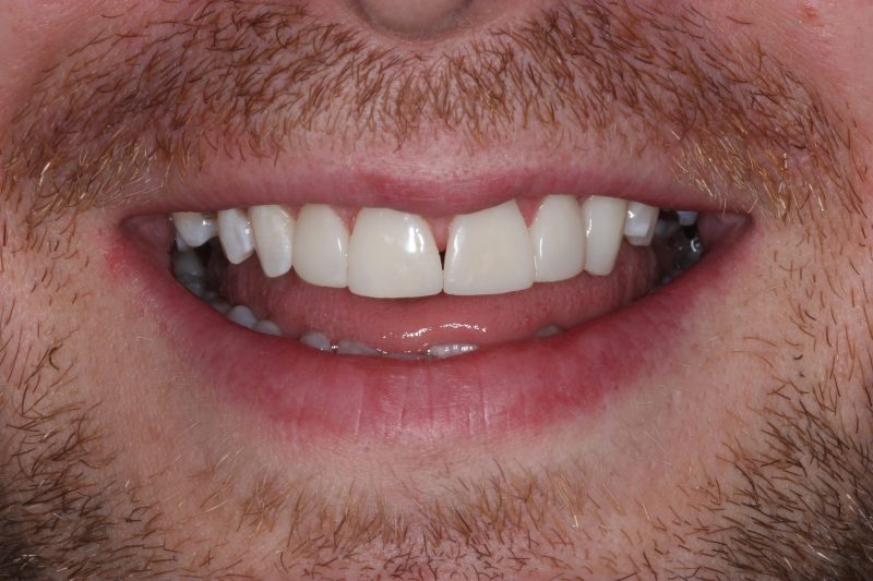 IMG_0062 After - Cheadle Hulme Dental