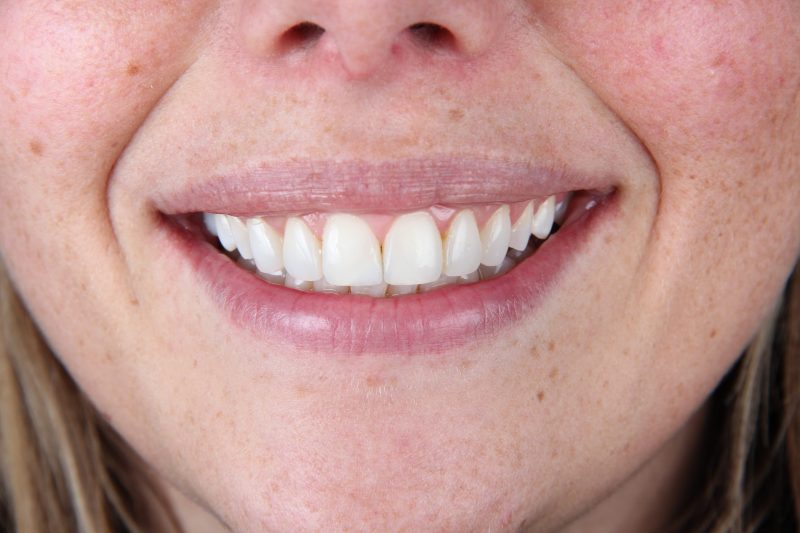 IMG_0085 After - Cheadle Hulme Dental