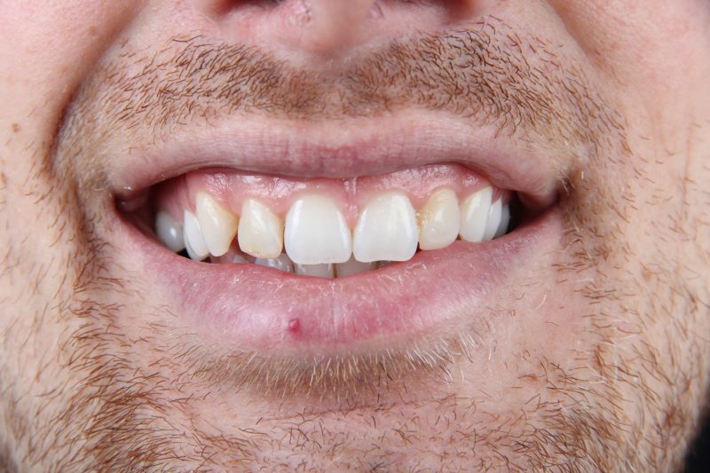 IMG_0091 Before - Cheadle Hulme Dental
