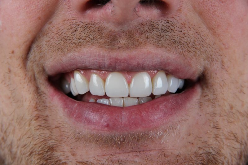 IMG_0563 After - Cheadle Hulme Dental