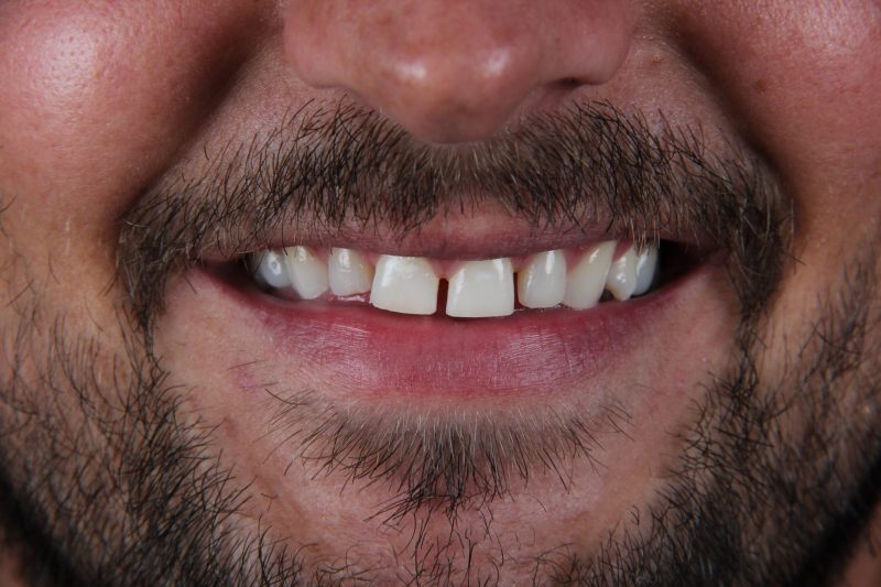 IMG_0624 Before - Cheadle Hulme Dental