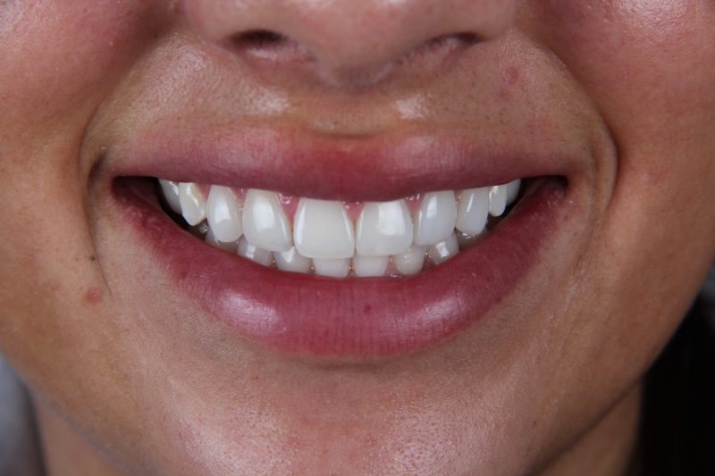 IMG_0762 After - Cheadle Hulme Dental