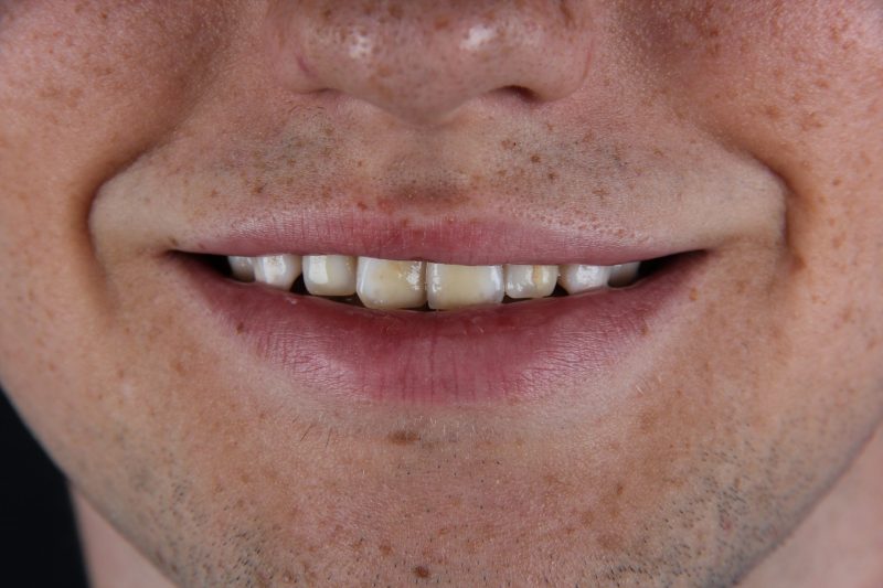 IMG_1286 Before - Cheadle Hulme Dental