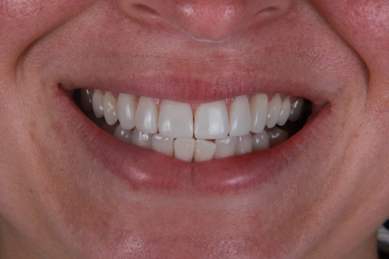 After - Cheadle Hulme Dental