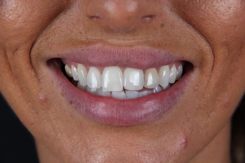 IMG_1571 Before - Cheadle Hulme Dental