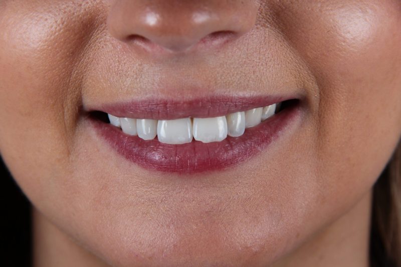 IMG_1599 Before - Cheadle Hulme Dental