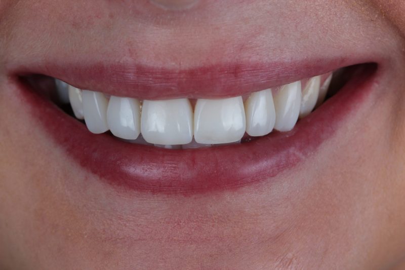 IMG_1683 After - Cheadle Hulme Dental