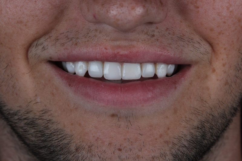 IMG_1719 After - Cheadle Hulme Dental