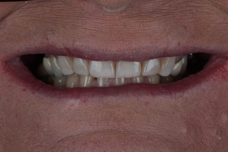 After - Cheadlehulme Dental