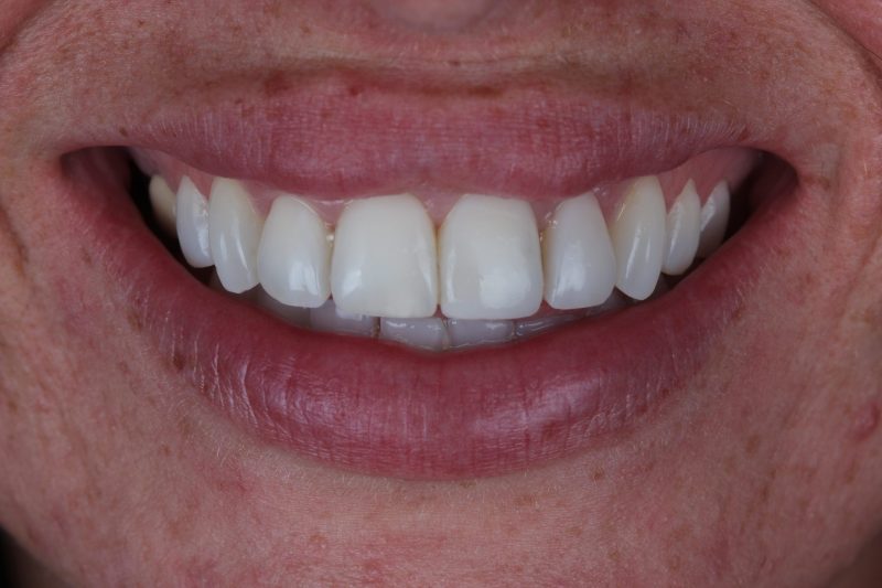 IMG_1807 After - Cheadle Hulme Dental