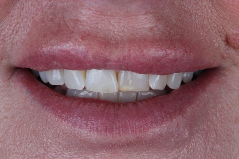 IMG_1865 Before - Cheadle Hulme Dental