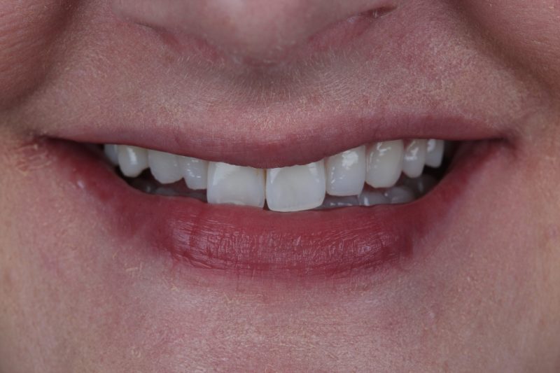 IMG_2027 Before - Cheadle Hulme Dental