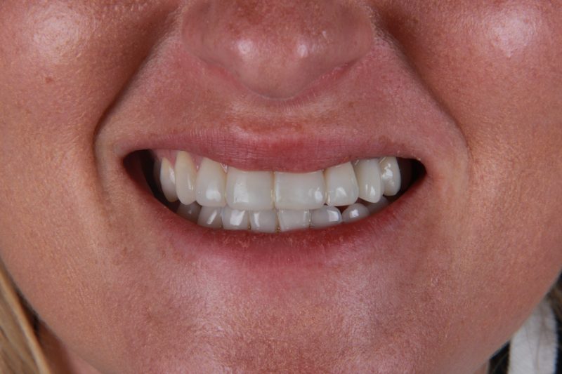 After - Cheadlehulme Dental