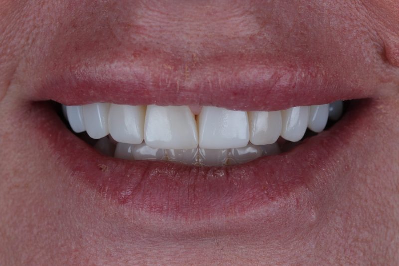 IMG_2157 After - Cheadle Hulme Dental