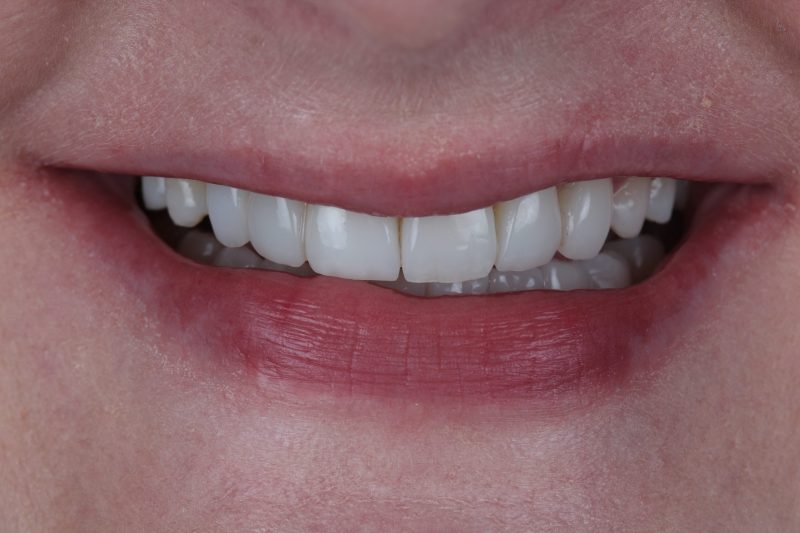IMG_2207 After - Cheadle Hulme Dental