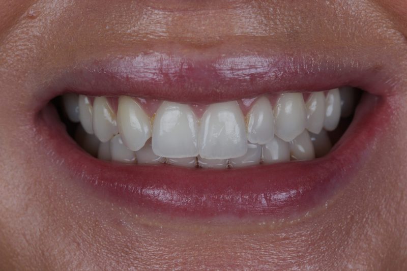 IMG_2310 Before - Cheadle Hulme Dental