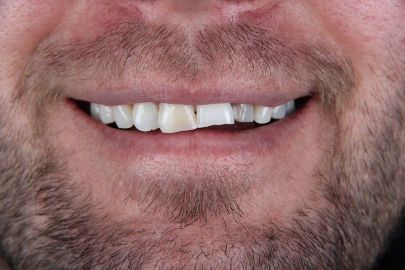 IMG_2423 Before - Cheadle Hulme Dental