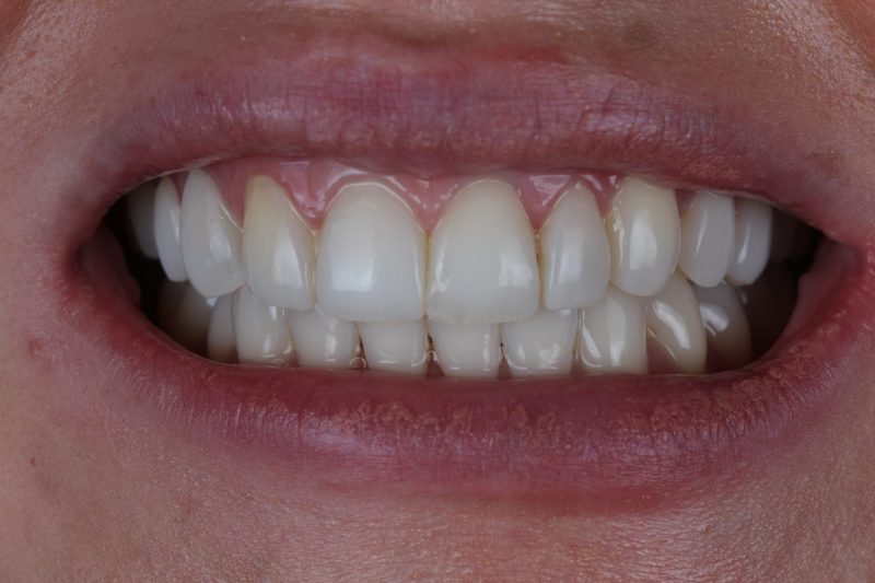 IMG_2436 After - Cheadle Hulme Dental