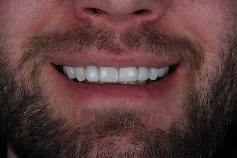 IMG_2499 After - Cheadle Hulme Dental