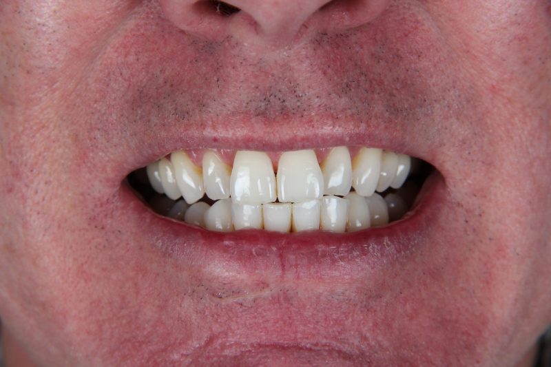 IMG_2607 Before - Cheadle Hulme Dental