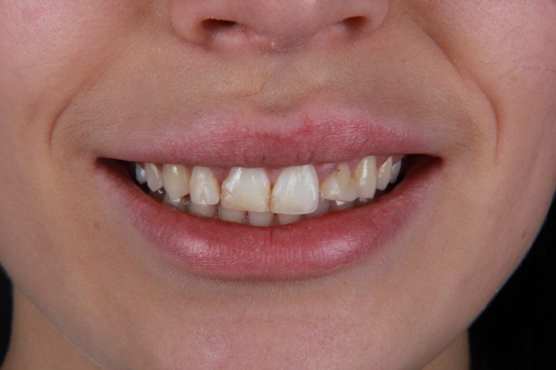 IMG_2624 Before - Cheadle Hulme Dental