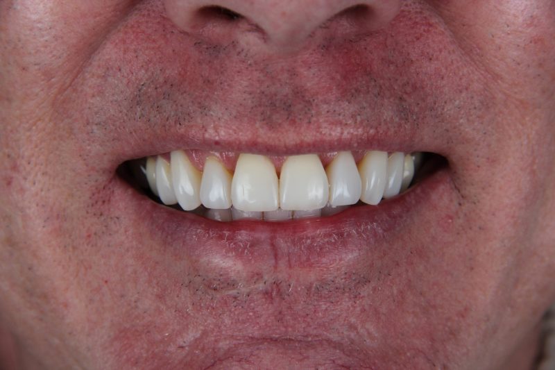 IMG_2759 After - Cheadle Hulme Dental