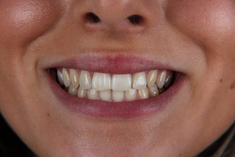 Before - Cheadlehulme Dental