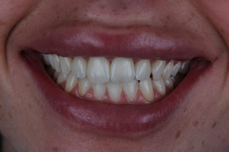 Before - Cheadlehulme Dental