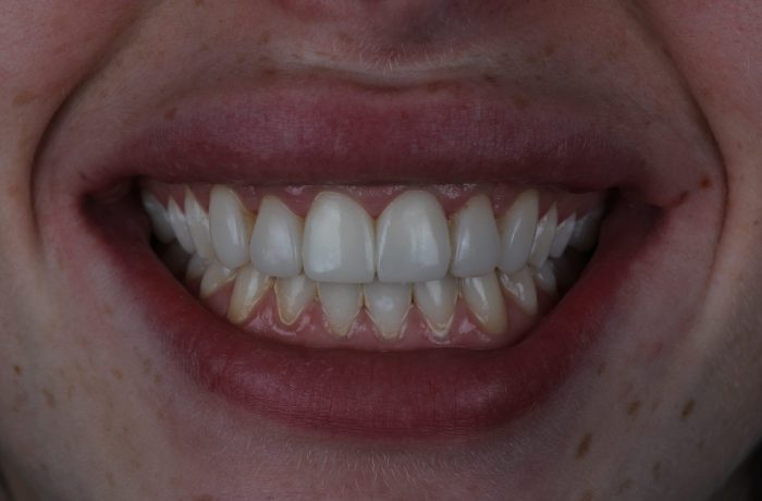 After - Cheadle Hulme Dental