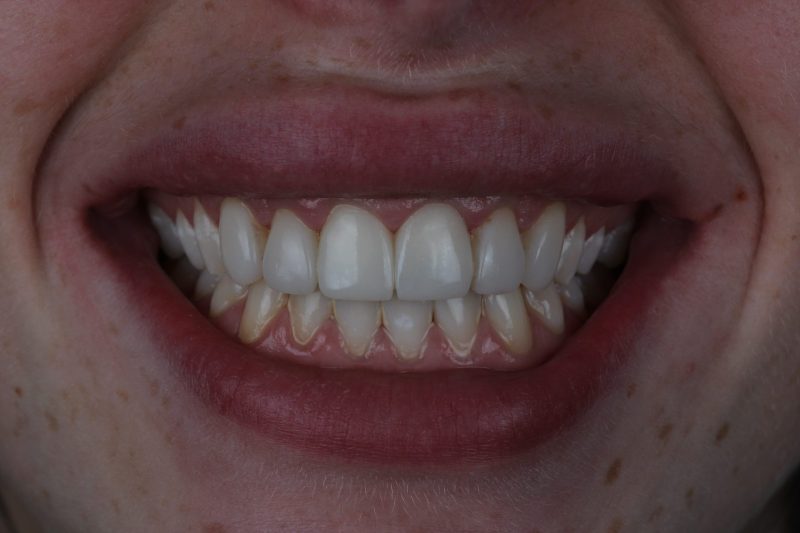 After - Cheadlehulme Dental