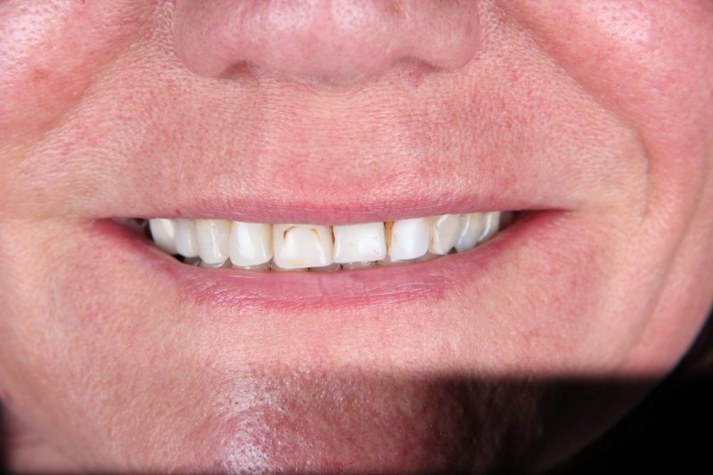 IMG_3217 Before - Cheadle Hulme Dental