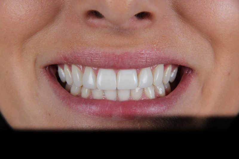 After - Cheadlehulme Dental